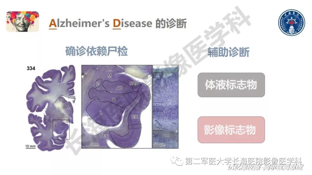 影像PPT - 【PPT】阿尔兹海默症 ——临床与影像-20