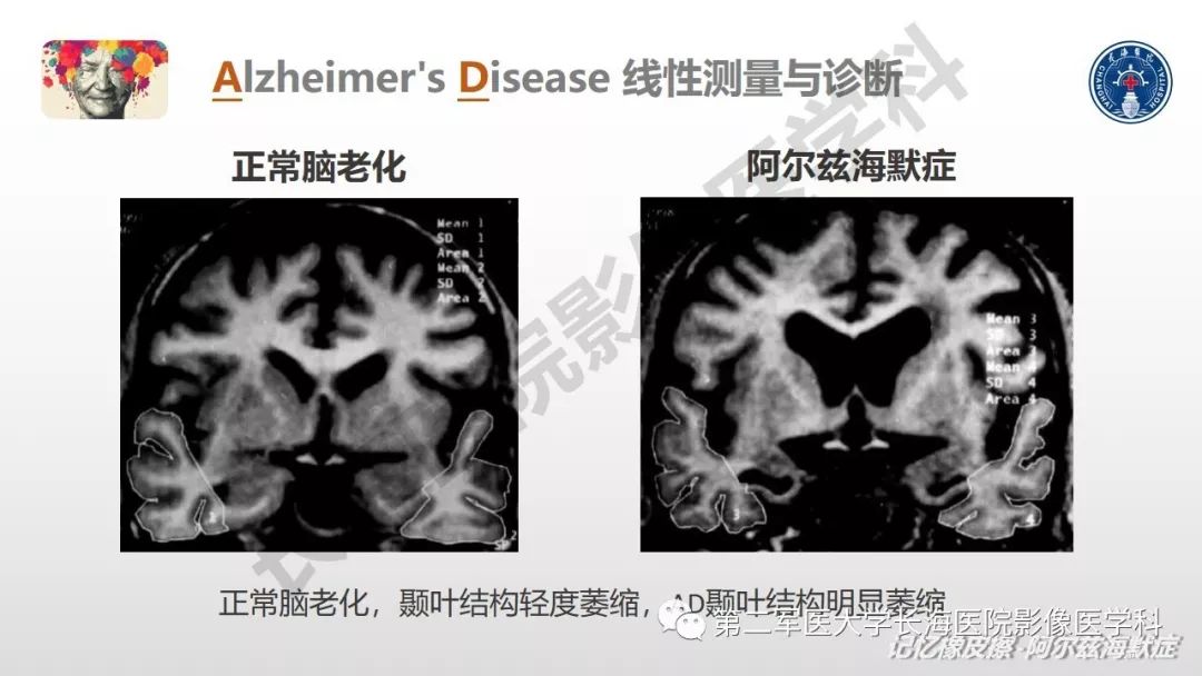 影像PPT - 【PPT】阿尔兹海默症 ——临床与影像-33