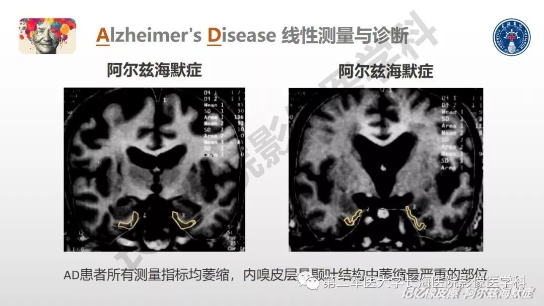 影像PPT - 【PPT】阿尔兹海默症 ——临床与影像-31