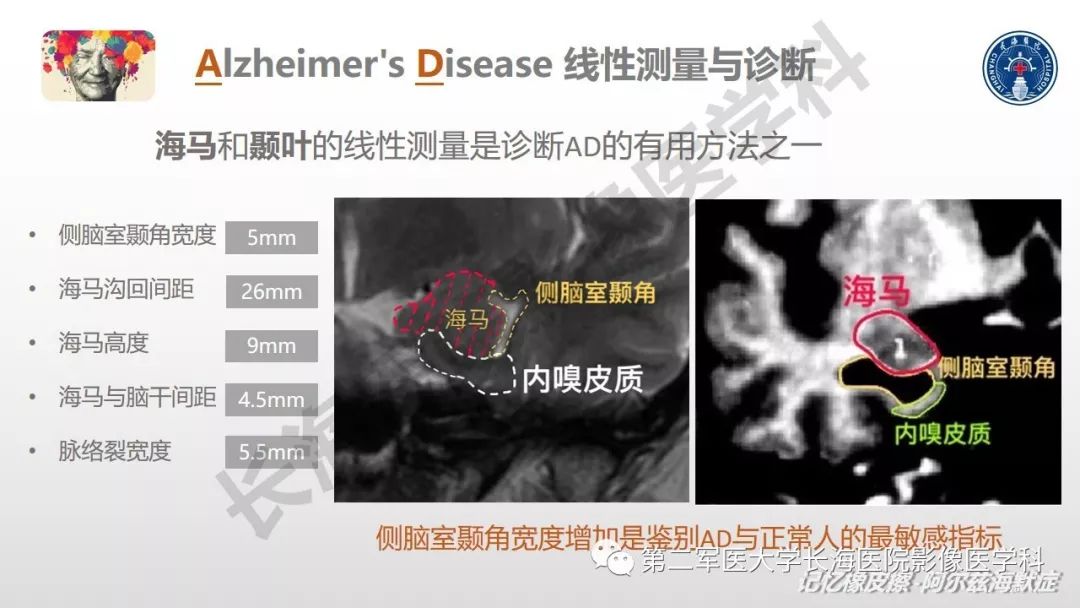 影像PPT - 【PPT】阿尔兹海默症 ——临床与影像-30