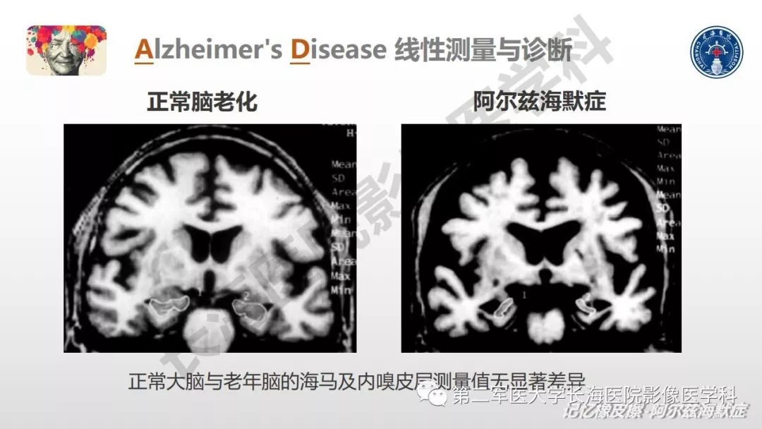 影像PPT - 【PPT】阿尔兹海默症 ——临床与影像-32