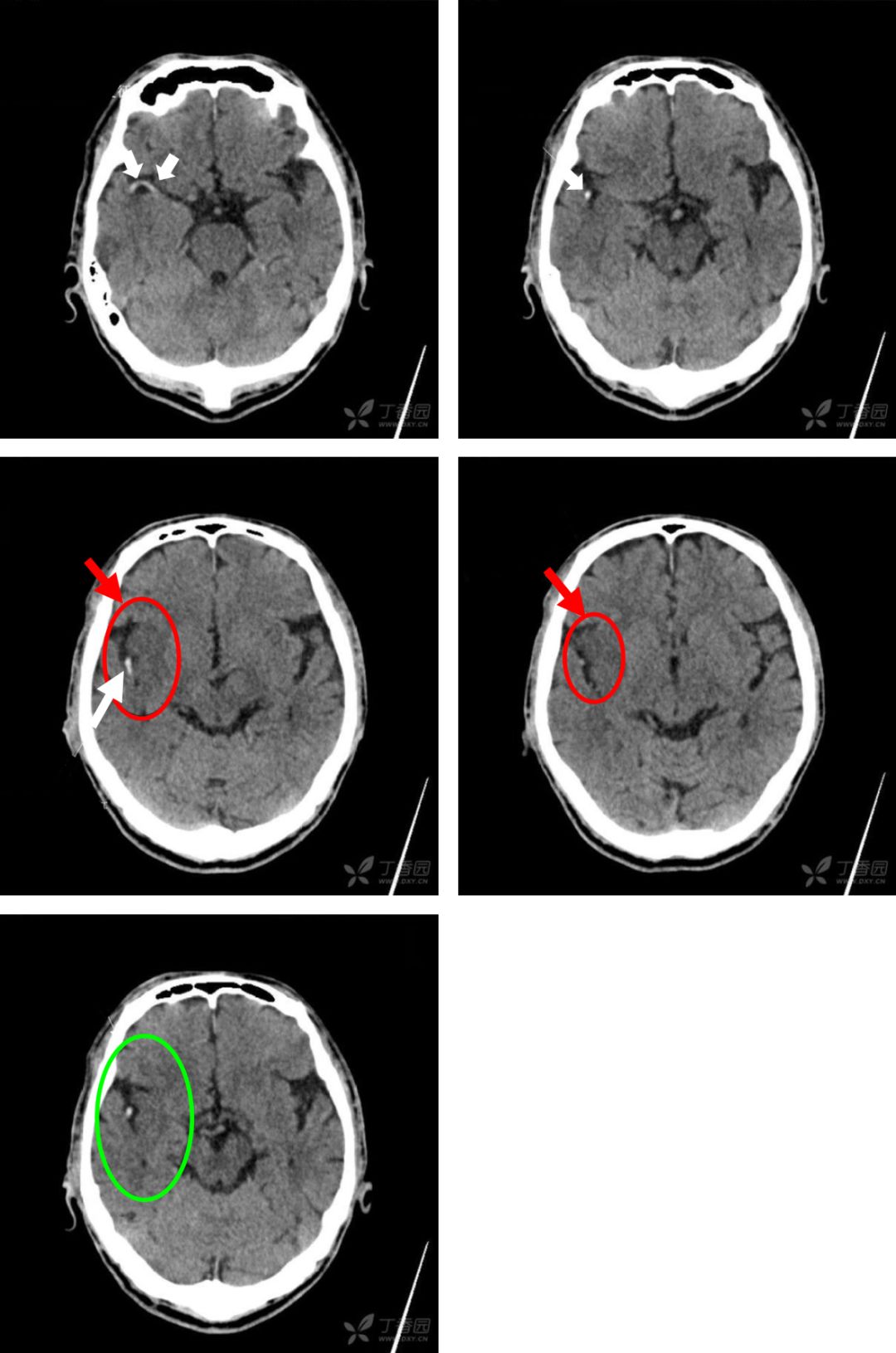 影像PPT - 6个病例学会脑梗死的4大CT征象-1 影像PPT - 6个病例学会脑梗死的4大CT征象-1