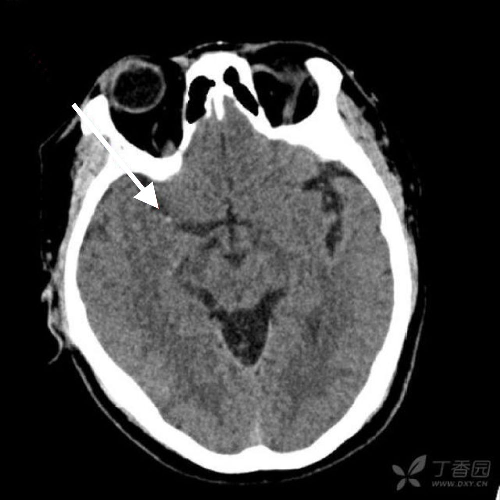影像PPT - 6个病例学会脑梗死的4大CT征象-2 影像PPT - 6个病例学会脑梗死的4大CT征象-2