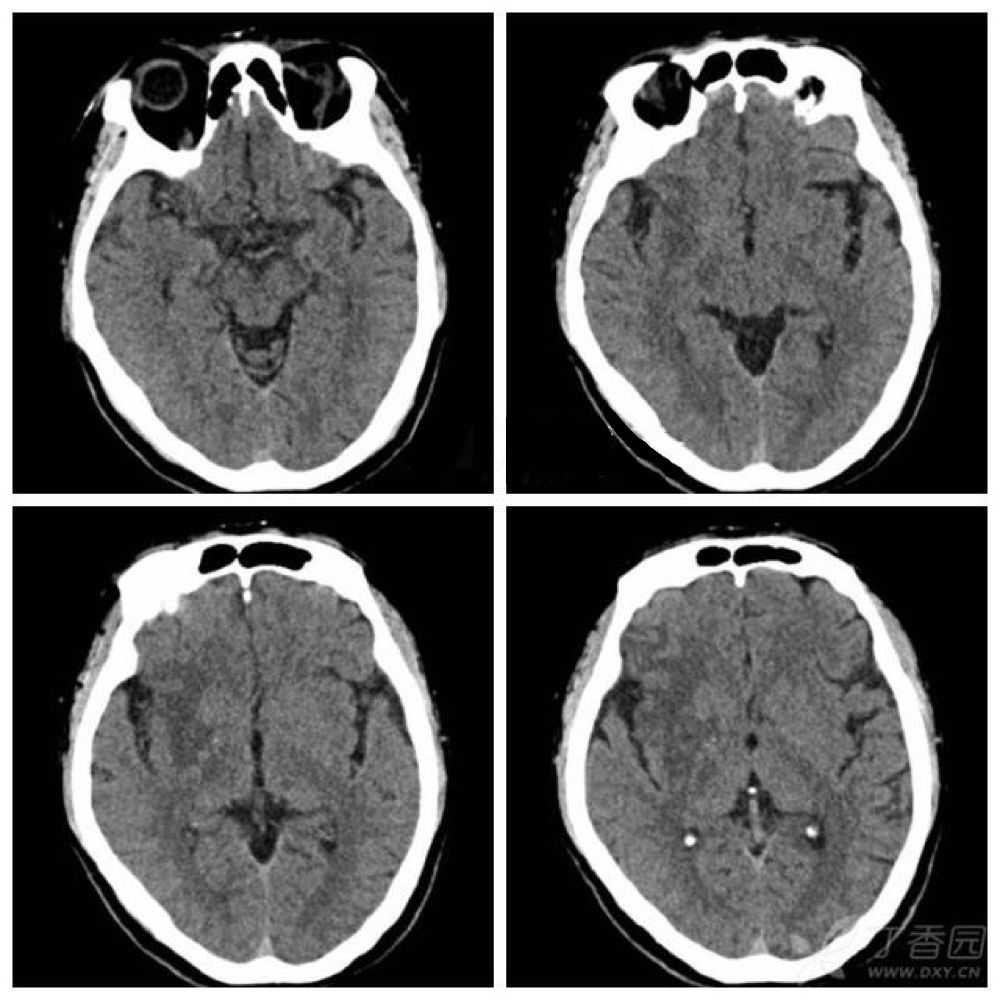 影像PPT - 6个病例学会脑梗死的4大CT征象-3 影像PPT - 6个病例学会脑梗死的4大CT征象-3