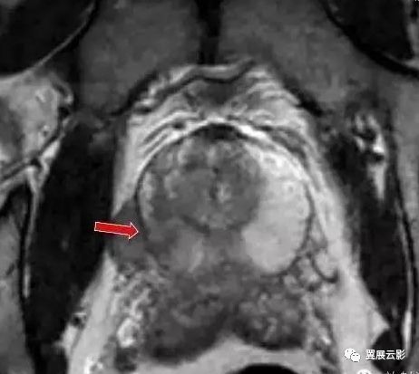 影像PPT - 泌尿生殖系统常见疾病MR诊断-11 影像PPT - 泌尿生殖系统常见疾病MR诊断-11