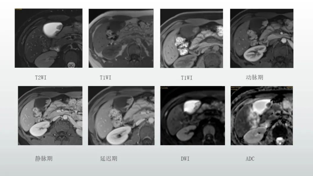 影像PPT - 【病例】胆囊腺癌1例CT及MR影像-4