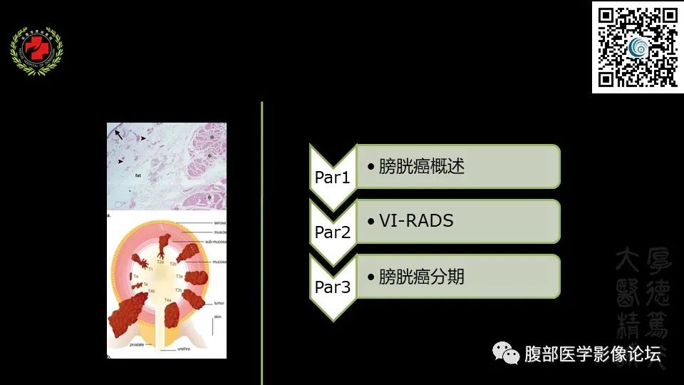 影像PPT - 【PPT】膀胱癌MRI诊断-2
