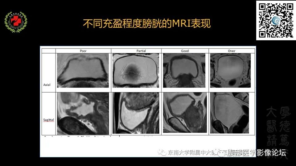 影像PPT - 【PPT】膀胱癌MRI诊断-12