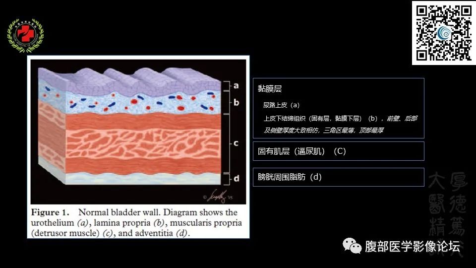 影像PPT - 【PPT】膀胱癌MRI诊断-17