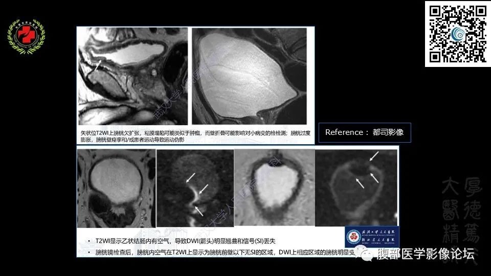 影像PPT - 【PPT】膀胱癌MRI诊断-13