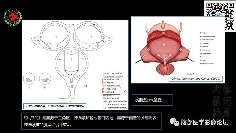 影像PPT - 【PPT】膀胱癌MRI诊断-19