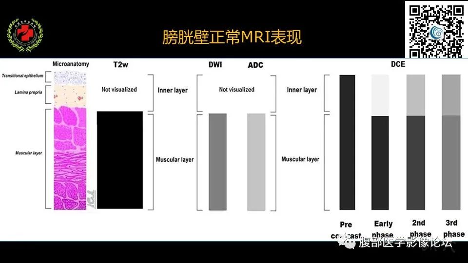 影像PPT - 【PPT】膀胱癌MRI诊断-20