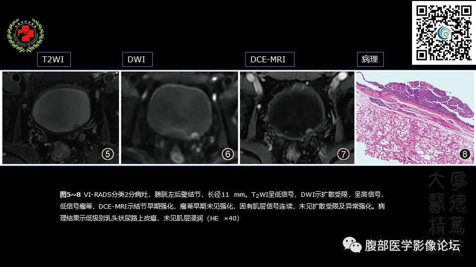 影像PPT - 【PPT】膀胱癌MRI诊断-31