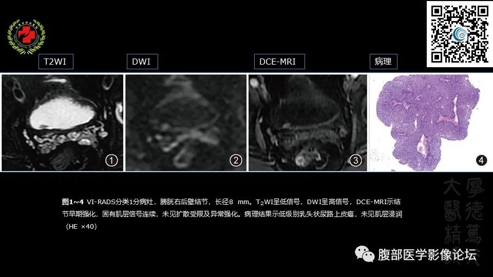 影像PPT - 【PPT】膀胱癌MRI诊断-30