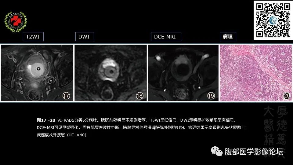 影像PPT - 【PPT】膀胱癌MRI诊断-34