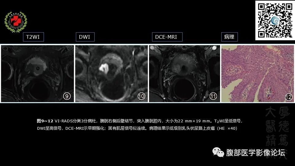 影像PPT - 【PPT】膀胱癌MRI诊断-32