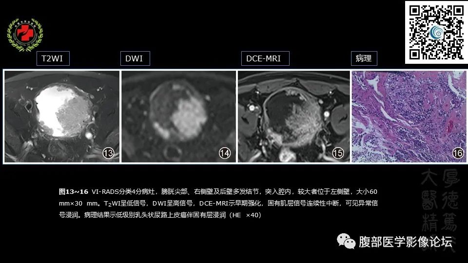 影像PPT - 【PPT】膀胱癌MRI诊断-33
