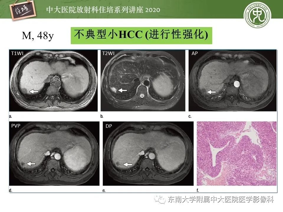 影像PPT - 【PPT】肝脏常见影像征象解读-11