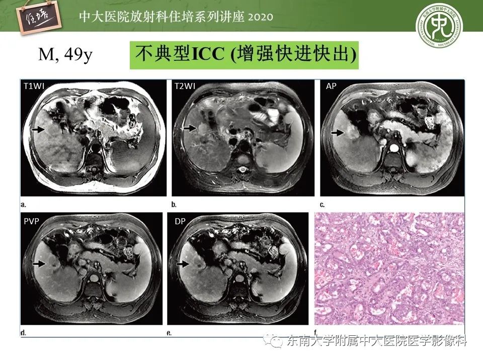 影像PPT - 【PPT】肝脏常见影像征象解读-10