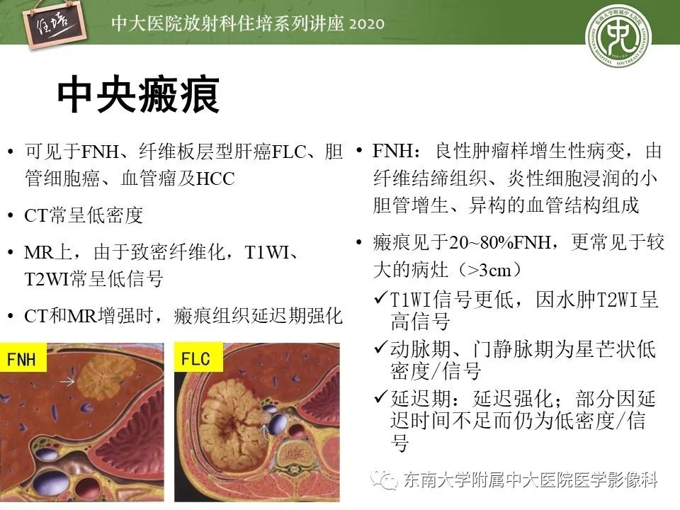影像PPT - 【PPT】肝脏常见影像征象解读-12