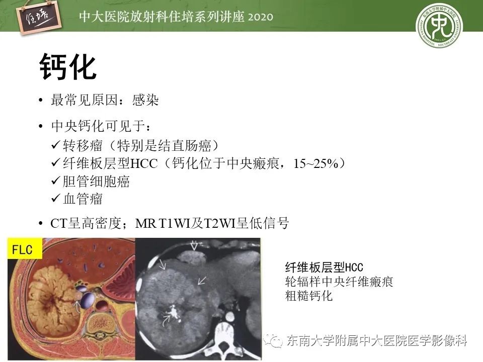 影像PPT - 【PPT】肝脏常见影像征象解读-14