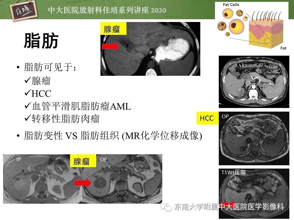 影像PPT - 【PPT】肝脏常见影像征象解读-15