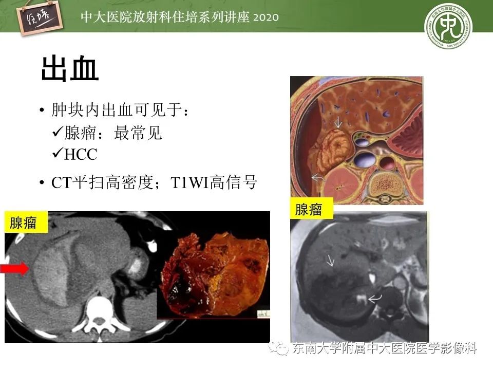 影像PPT - 【PPT】肝脏常见影像征象解读-16