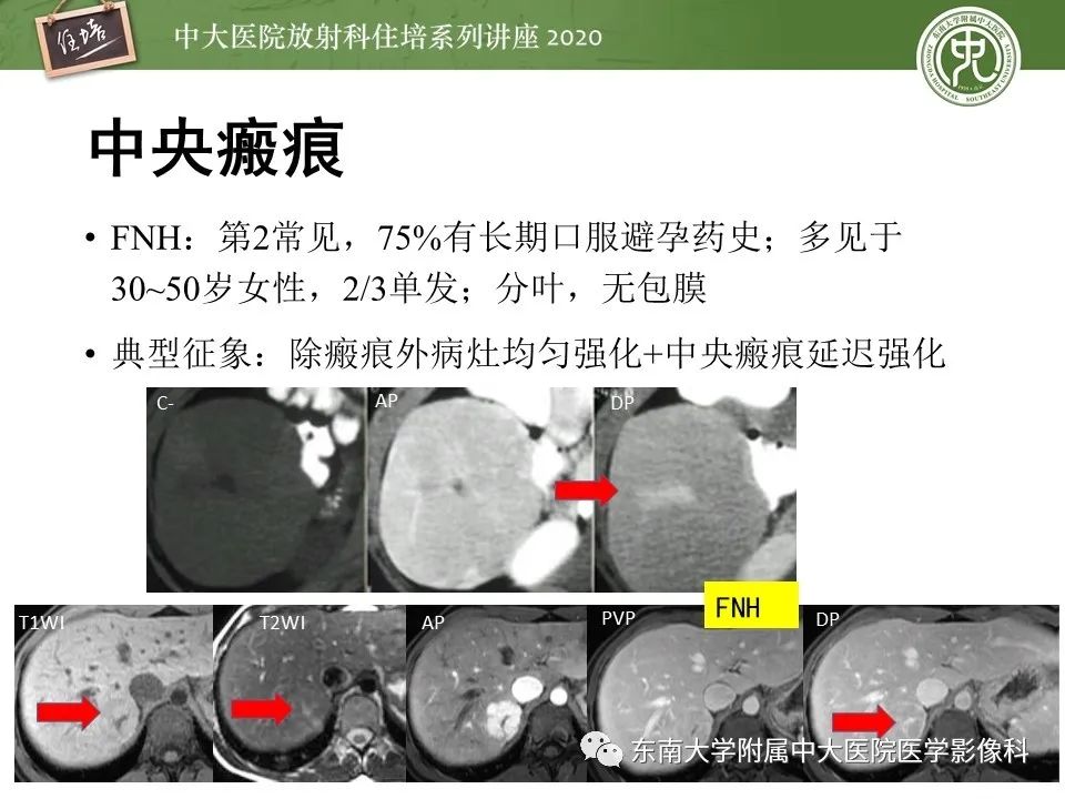 影像PPT - 【PPT】肝脏常见影像征象解读-13