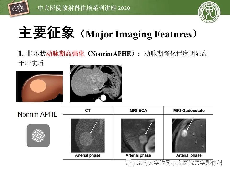 影像PPT - 【PPT】肝脏常见影像征象解读-19