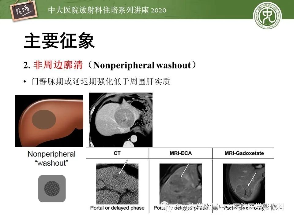 影像PPT - 【PPT】肝脏常见影像征象解读-20