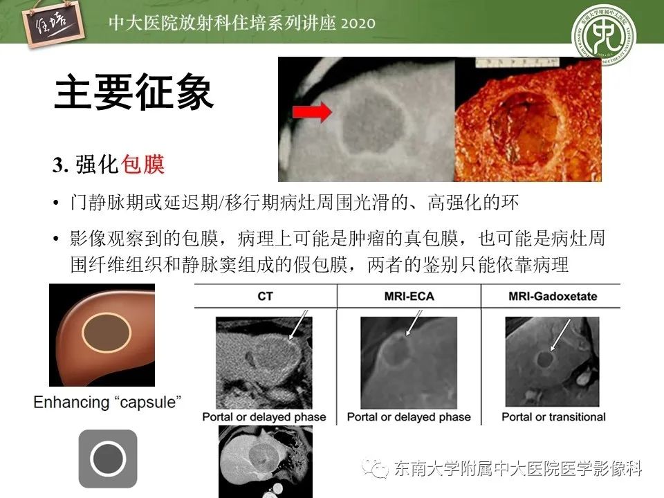 影像PPT - 【PPT】肝脏常见影像征象解读-21