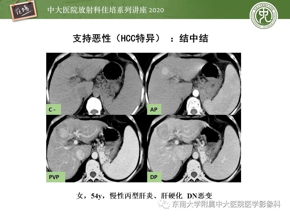 影像PPT - 【PPT】肝脏常见影像征象解读-25