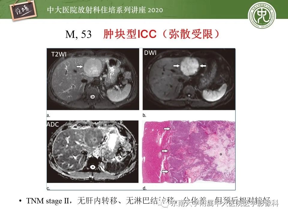 影像PPT - 【PPT】肝脏常见影像征象解读-28