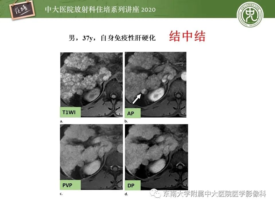 影像PPT - 【PPT】肝脏常见影像征象解读-26