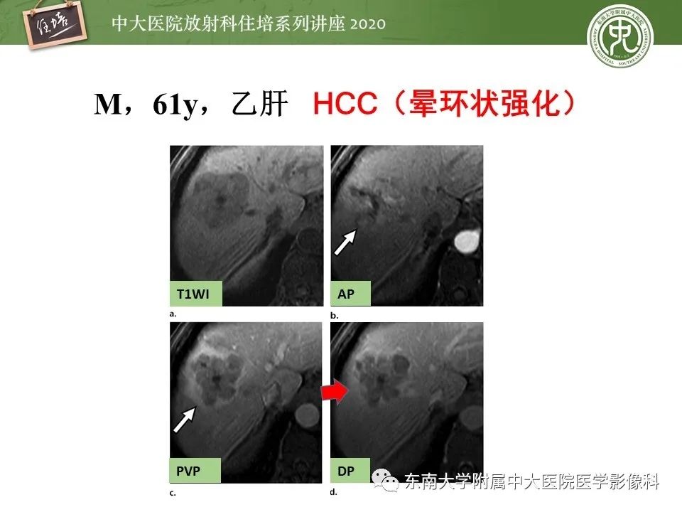 影像PPT - 【PPT】肝脏常见影像征象解读-30