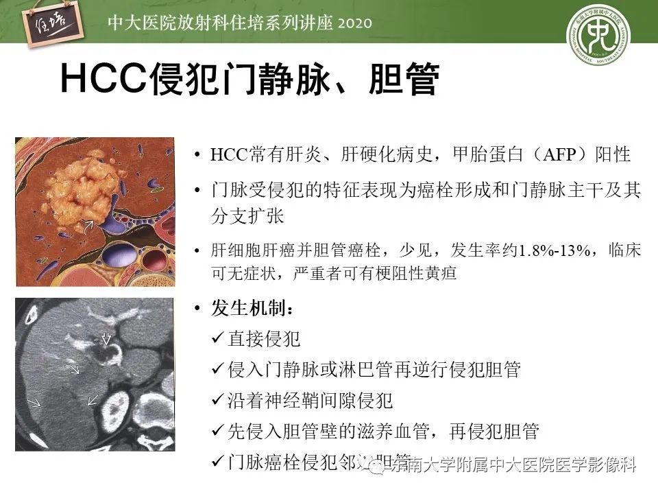 影像PPT - 【PPT】肝脏常见影像征象解读-34