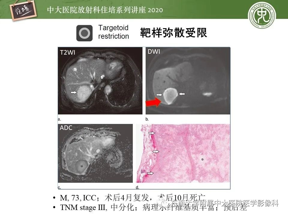 影像PPT - 【PPT】肝脏常见影像征象解读-33