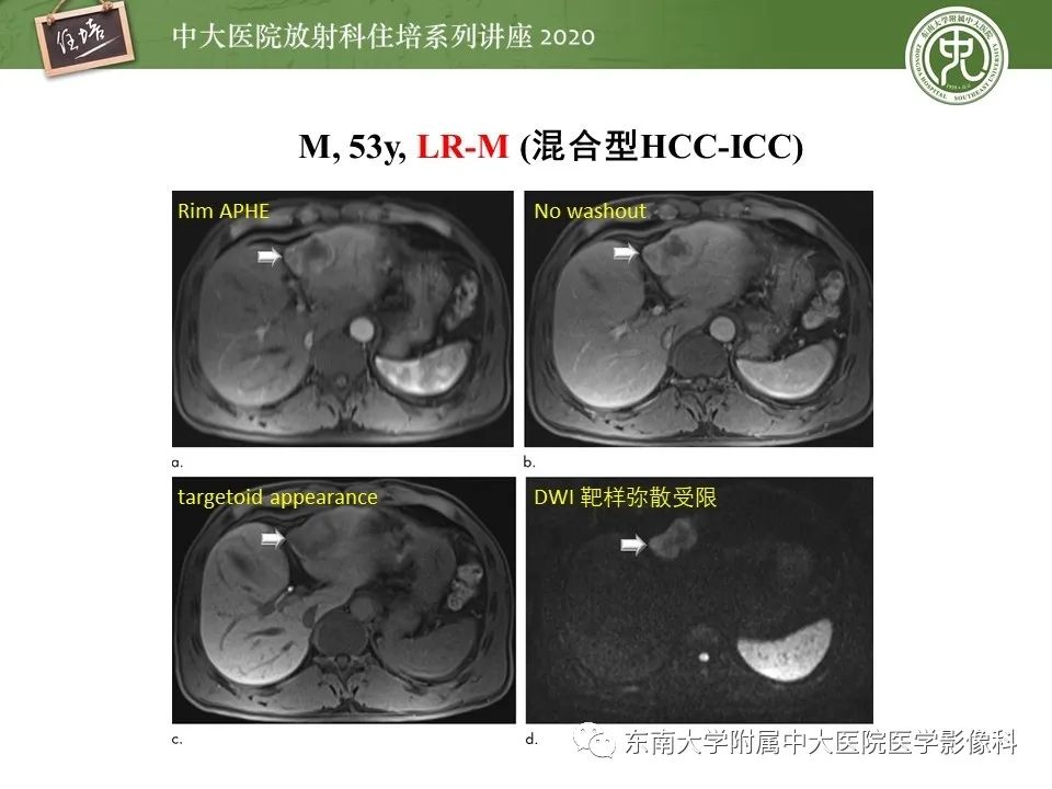 影像PPT - 【PPT】肝脏常见影像征象解读-32