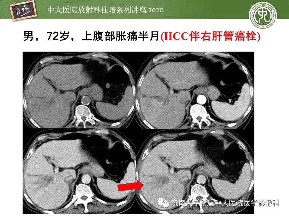 影像PPT - 【PPT】肝脏常见影像征象解读-35