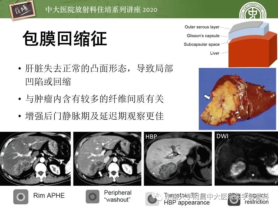 影像PPT - 【PPT】肝脏常见影像征象解读-37