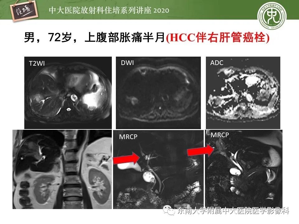 影像PPT - 【PPT】肝脏常见影像征象解读-36
