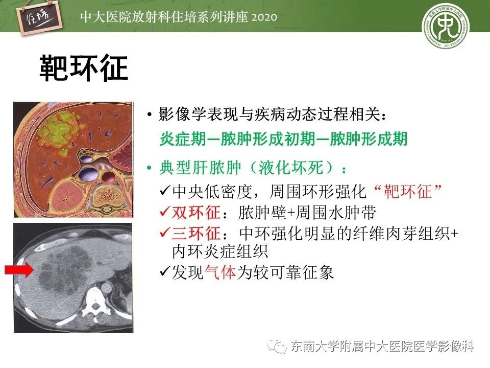 影像PPT - 【PPT】肝脏常见影像征象解读-41