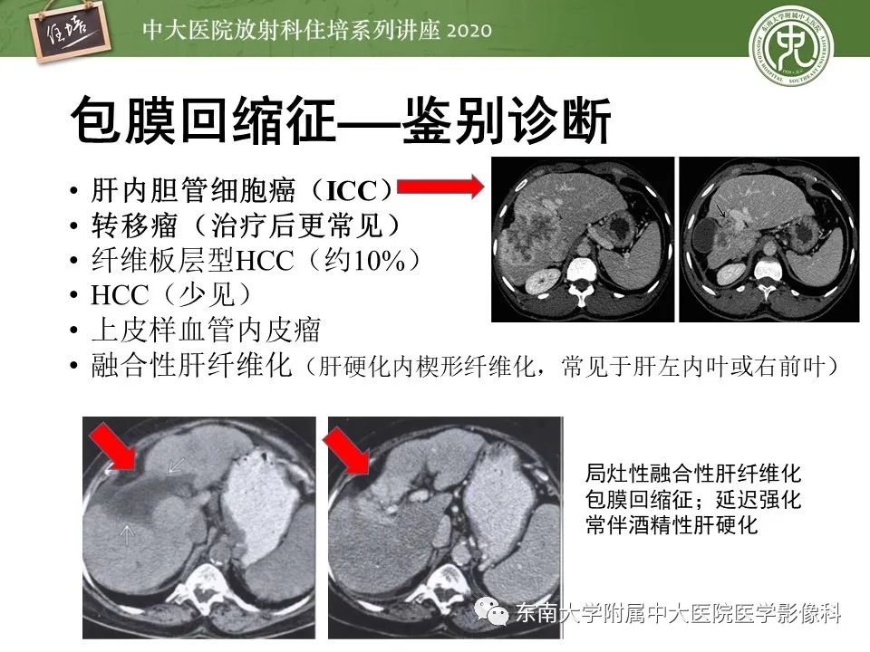 影像PPT - 【PPT】肝脏常见影像征象解读-38