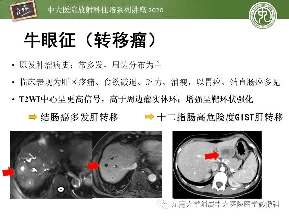影像PPT - 【PPT】肝脏常见影像征象解读-40