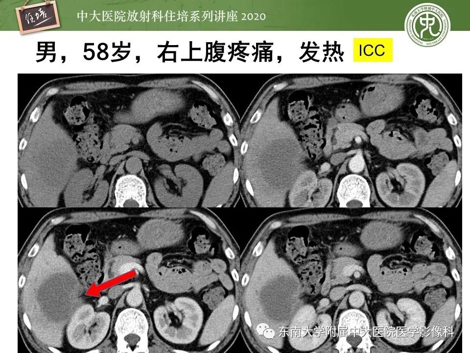 影像PPT - 【PPT】肝脏常见影像征象解读-39
