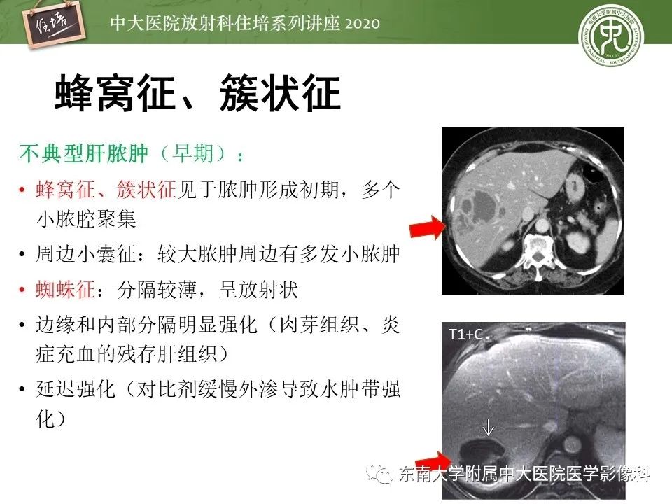 影像PPT - 【PPT】肝脏常见影像征象解读-42