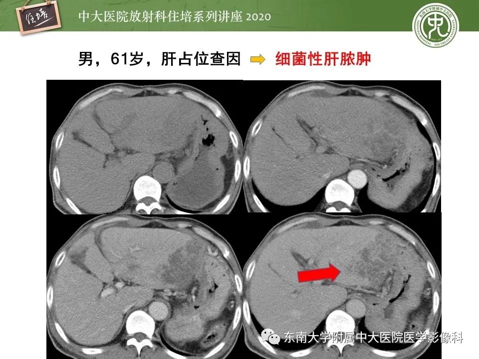 影像PPT - 【PPT】肝脏常见影像征象解读-43