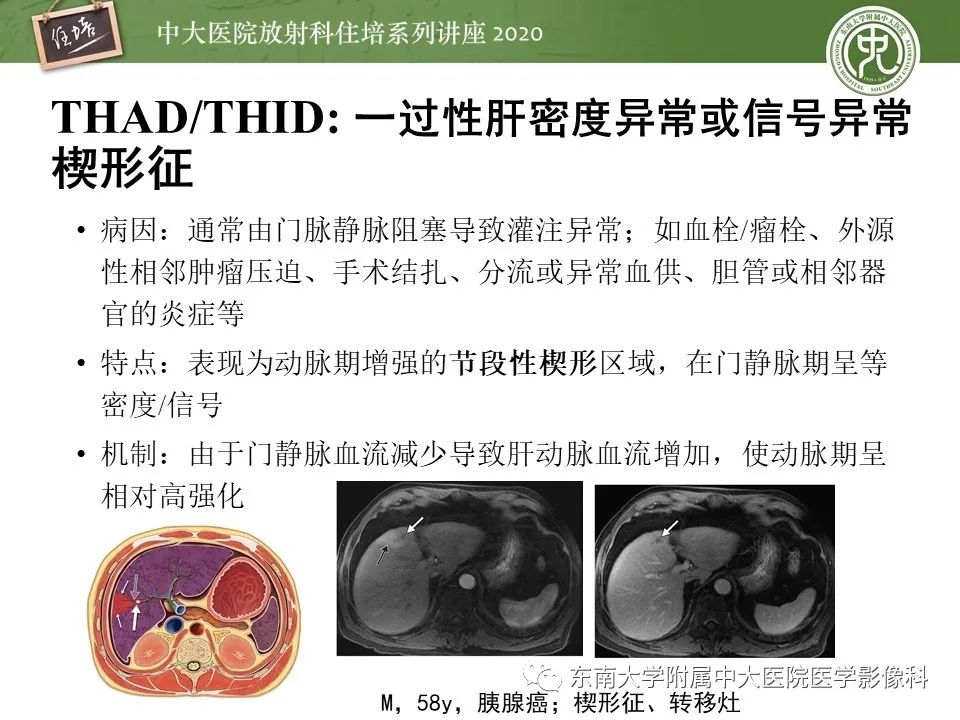 影像PPT - 【PPT】肝脏常见影像征象解读-47