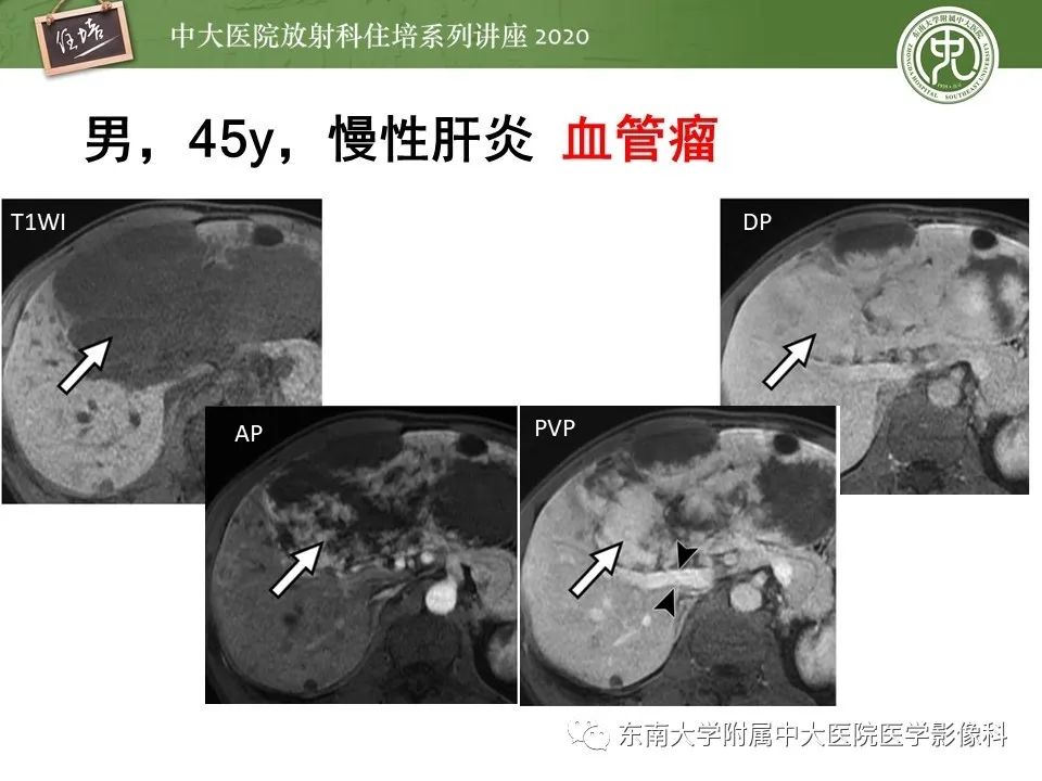 影像PPT - 【PPT】肝脏常见影像征象解读-46