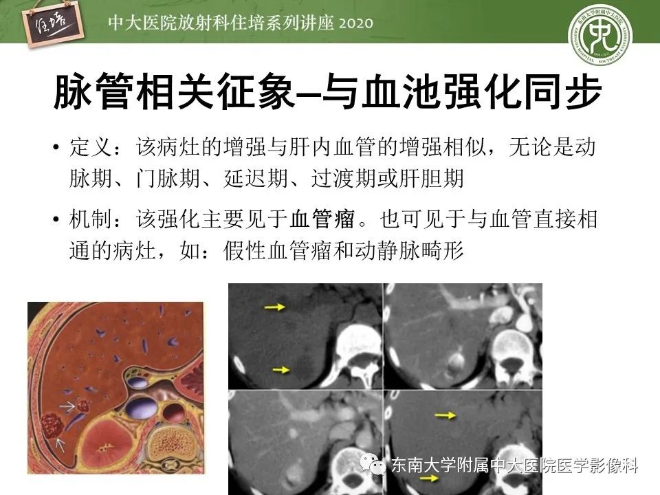 影像PPT - 【PPT】肝脏常见影像征象解读-45